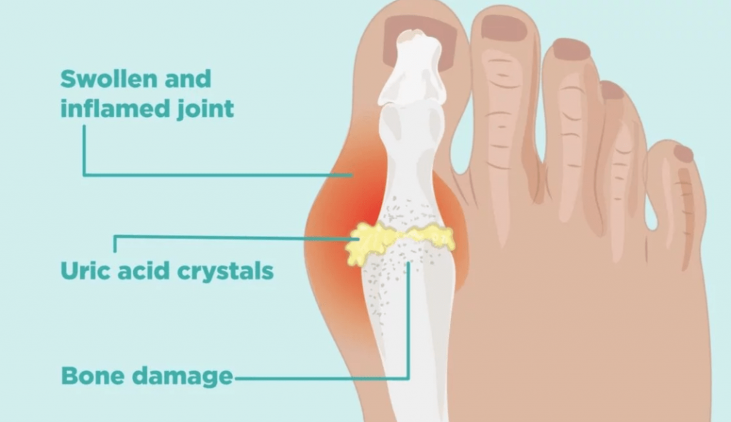 The End of Gout Review 2020 Really This Helps You to Fight?